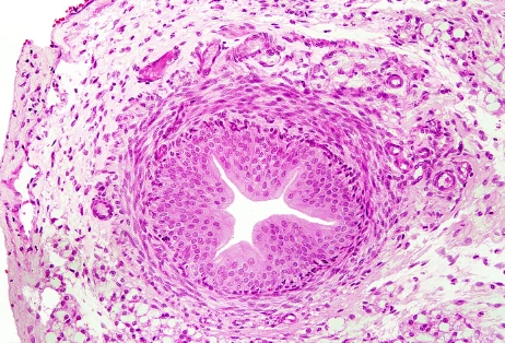tet ureter