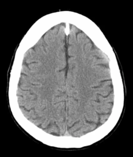 Encéfalo por TC / Axial - 4