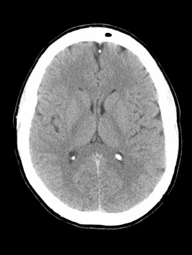 Encéfalo por TC / Axial - 1