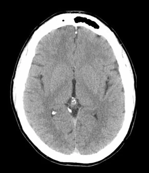 Encéfalo por TC / Axial - 2