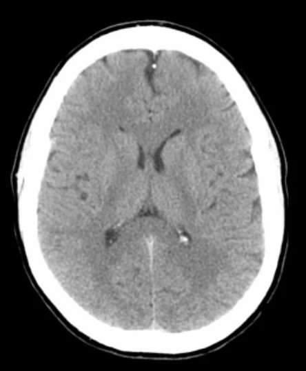 Encéfalo por TC / Axial - 3